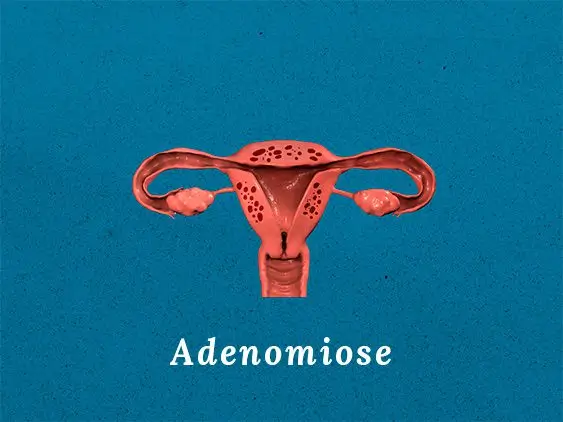 Adenomiose