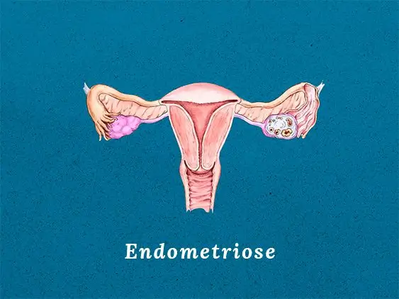 Endometriose