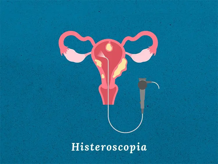 Histeroscopia