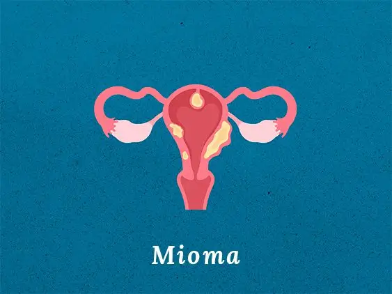 Mioma