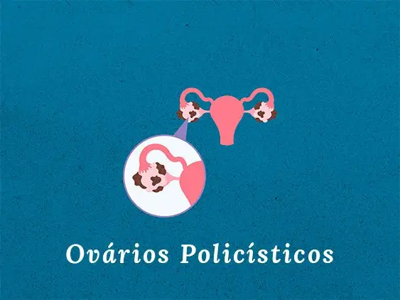 Ovários Policísticos