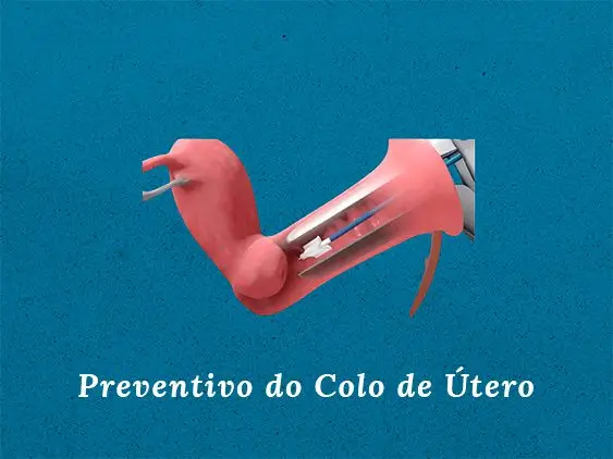 Preventivo do Colo de Útero
